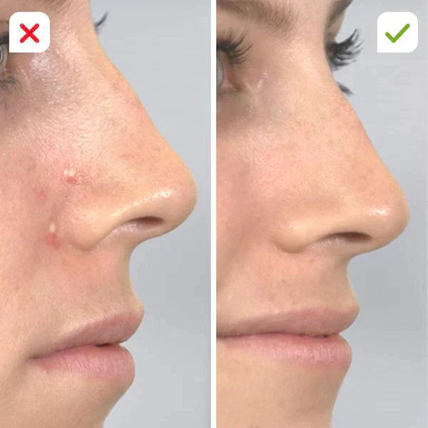 PIMPLE & BLACKHEAD REMOVER